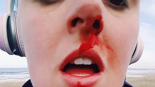 agresión a una joven nariz ensangrentada