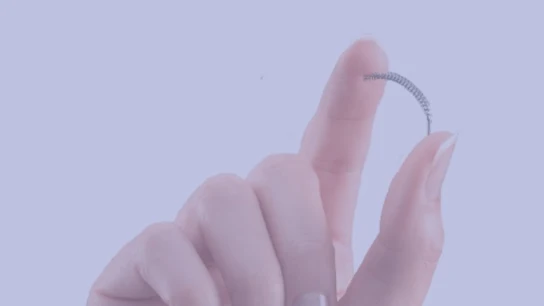 Essure es un pequeño muelle que se usa como anticonceptivo Essure es un pequeño muelle que se usa como anticonceptivo