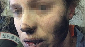 Una mujer con lesiones faciales después de que los auriculares que llevaba explotaran
