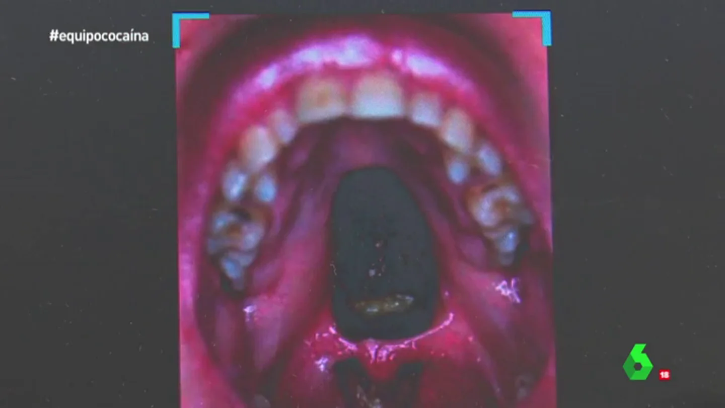 Frame 159.399491 de: Disminución del sueño, destrucción de la nariz, desgaste de los dientes… los atroces efectos de la cocaína Frame 159.399491 de: Disminución del sueño, destrucción de la nariz, desgaste de los dientes… los atroces efectos de la cocaína