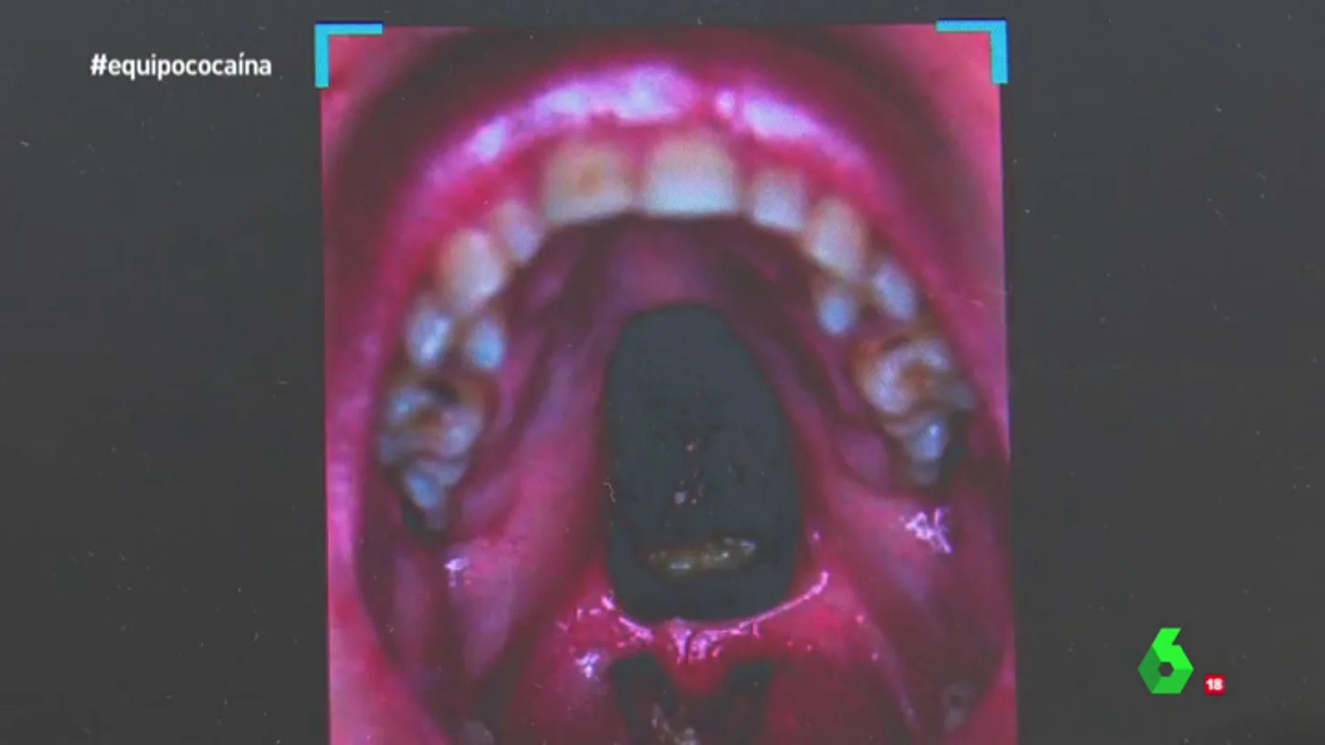 Frame 159.399491 de: Disminución del sueño, destrucción de la nariz, desgaste de los dientes… los atroces efectos de la cocaína