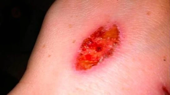 Un nuevo reto que consiste en levantarse la piel con una goma se viraliza entre los jóvenes Un nuevo reto que consiste en levantarse la piel con una goma se viraliza entre los jóvenes