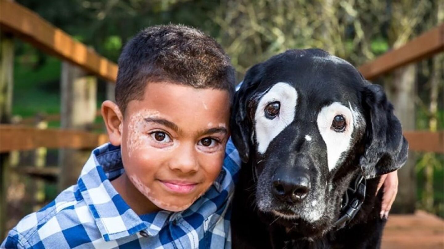 vitiligo