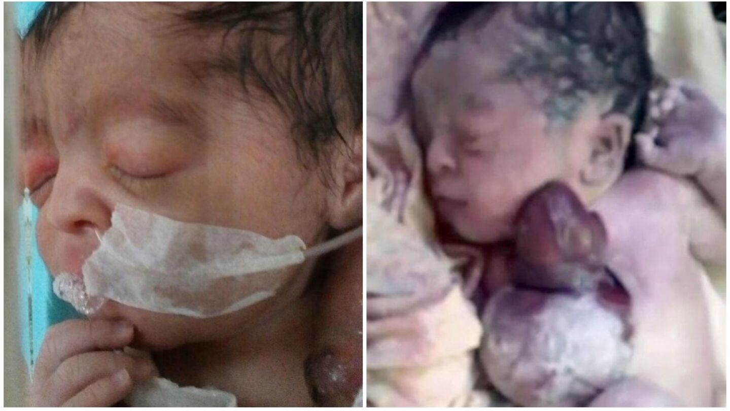 Un beb&eacute; nace con el coraz&oacute;n completamente fuera de su cuerpo en Pakist&aacute;n