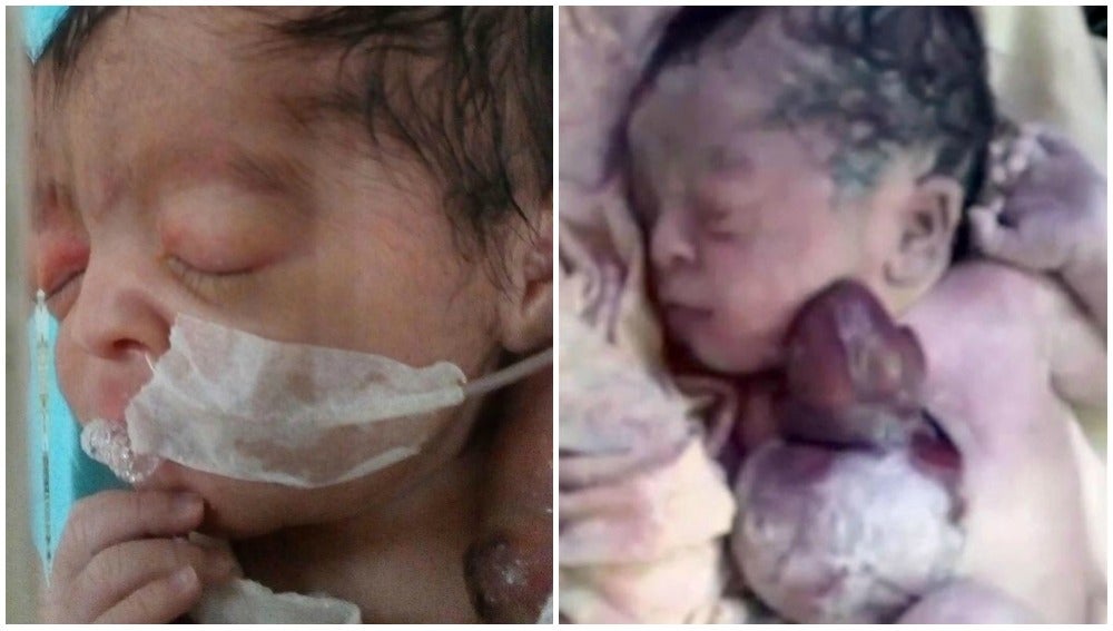 Un bebé nace con el corazón completamente fuera de su cuerpo en Pakistán