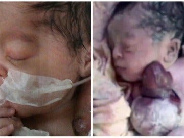 Un bebé nace con el corazón completamente fuera de su cuerpo en Pakistán Un bebé nace con el corazón completamente fuera de su cuerpo en Pakistán