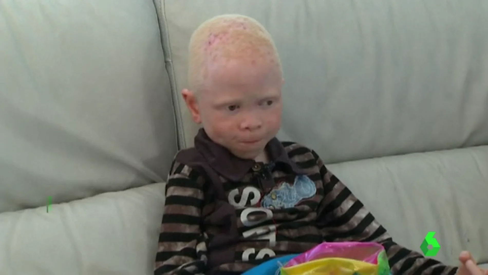 Niño albino negro