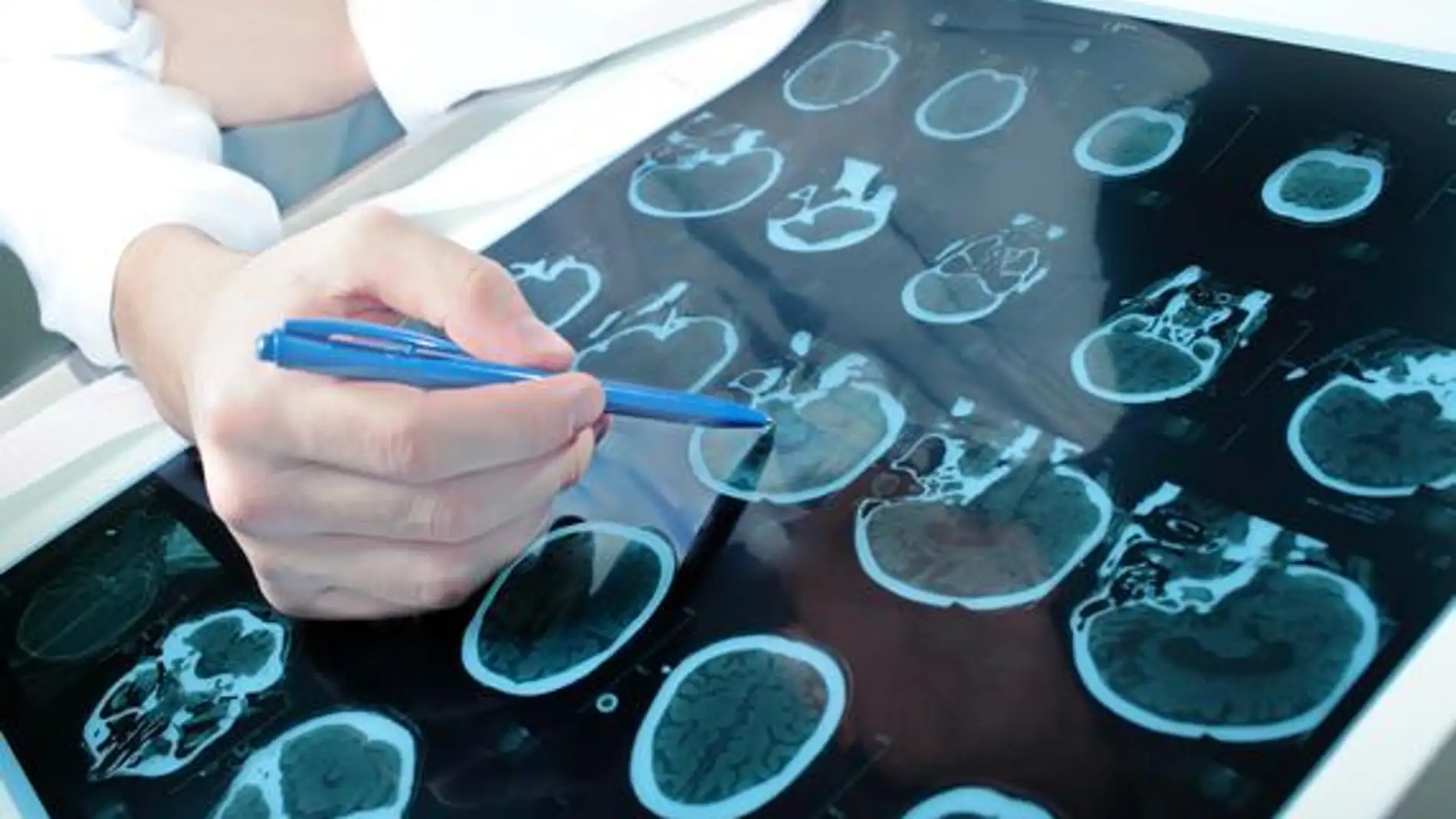 Investigadores de la Universidad de León han probado que el ácido 2OAA tiene efectos neuroprotectores en ratas