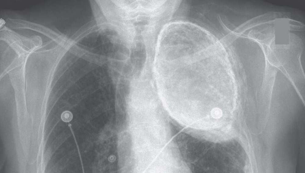 La radiografía desveló el aceite que albergaba uno de sus pulmones