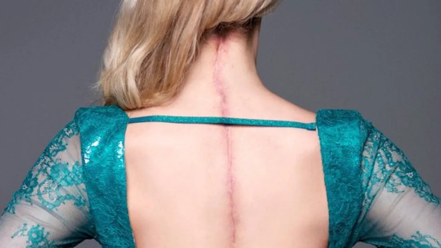 Una joven reina de la belleza muestra la cicatriz que recorre su espalda Una joven reina de la belleza muestra la cicatriz que recorre su espalda