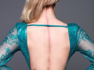 Una joven reina de la belleza muestra la cicatriz que recorre su espalda Una joven reina de la belleza muestra la cicatriz que recorre su espalda