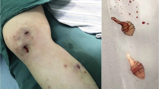 A la izquierda las picaduras provocadas por las larvas de la foto de la derecha A la izquierda las picaduras provocadas por las larvas de la foto de la derecha