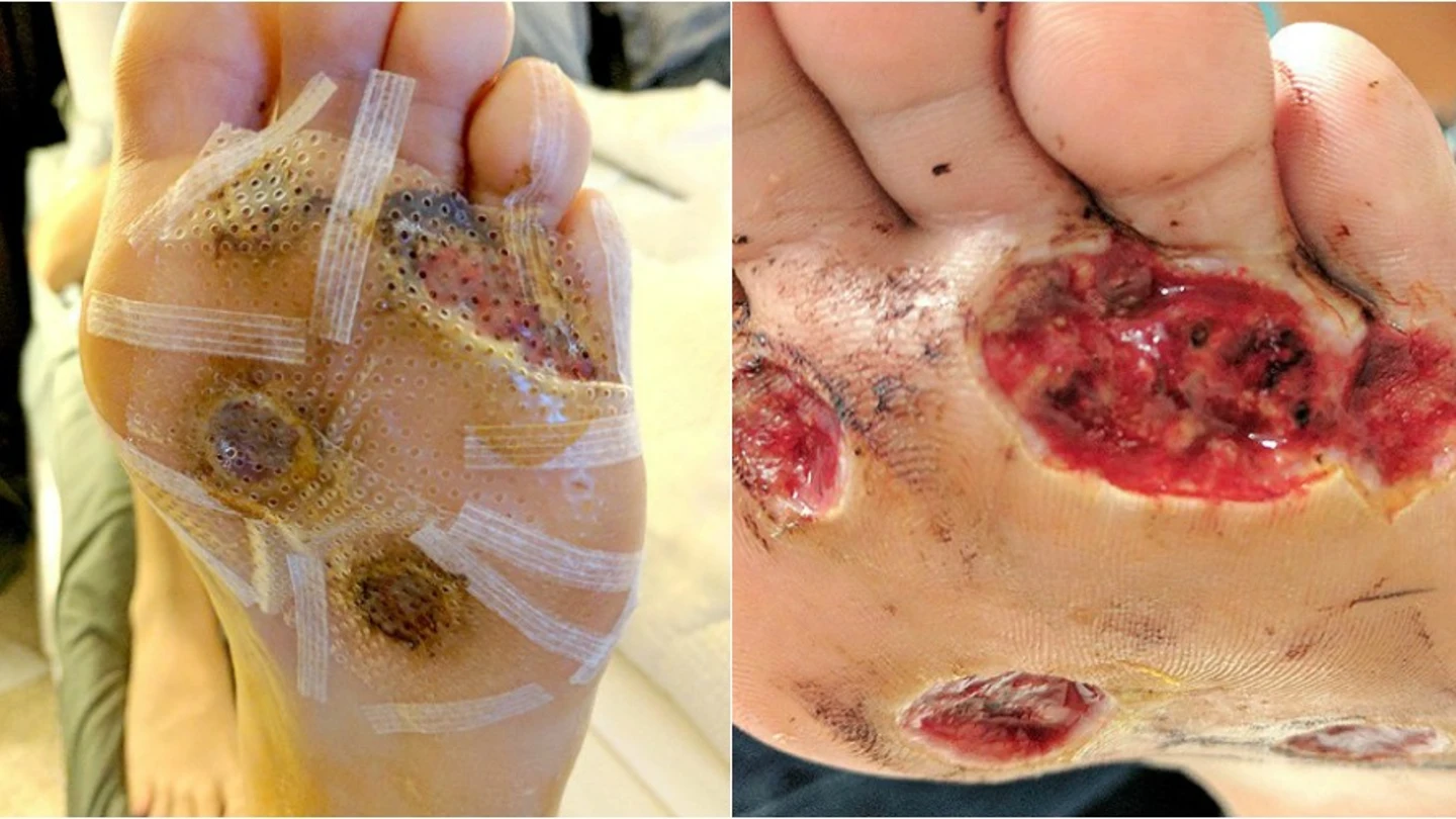 La piel de los pies pronto dividida en cinco verrugas La piel de los pies dividida en cinco verrugas