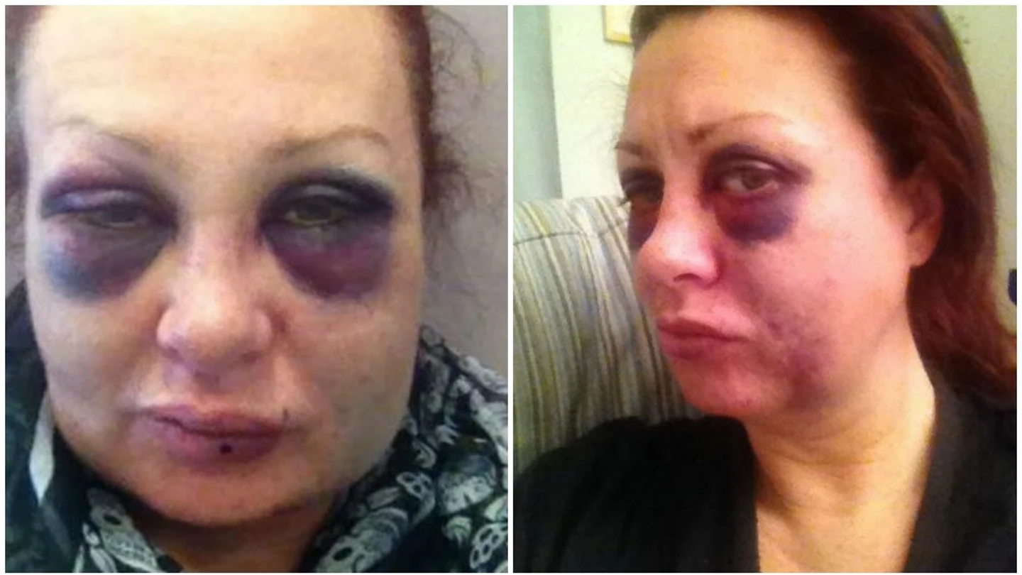 Una mujer sufre una brutal paliza por su exnovio y se hace fotos durante un mes para concienciar a otras mujeres Una mujer sufre una brutal paliza por su exnovio y se hace fotos durante un mes para concienciar a otras mujeres