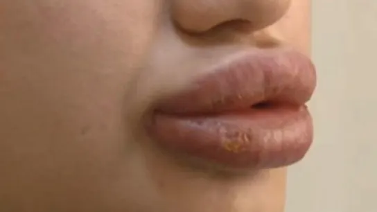 Labios de Merve Kales tras la inyección de la sustancia desconocida Labios de Merve Kales tras la inyección de la sustancia desconocida