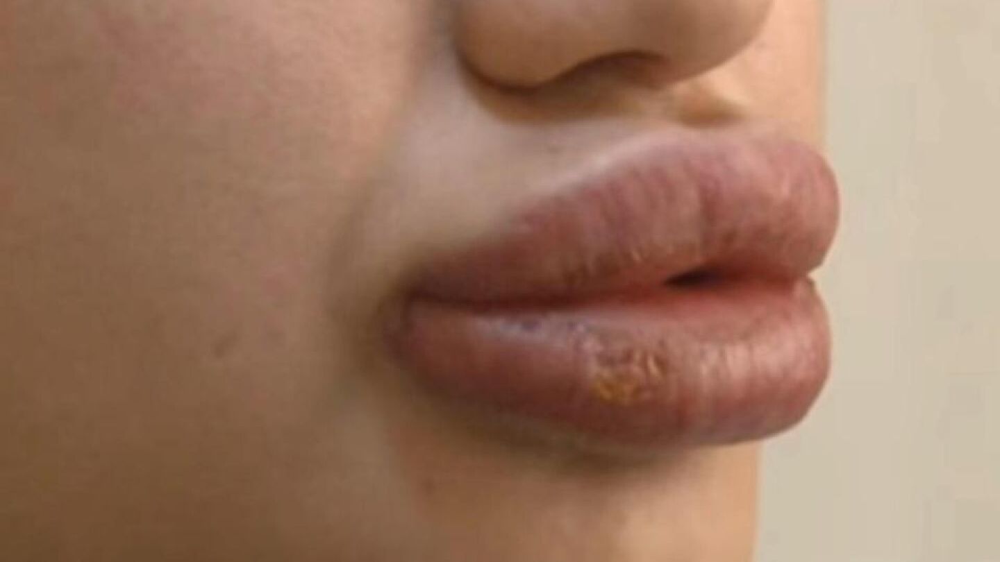 Labios de Merve Kales tras la inyecci&oacute;n de la sustancia desconocida