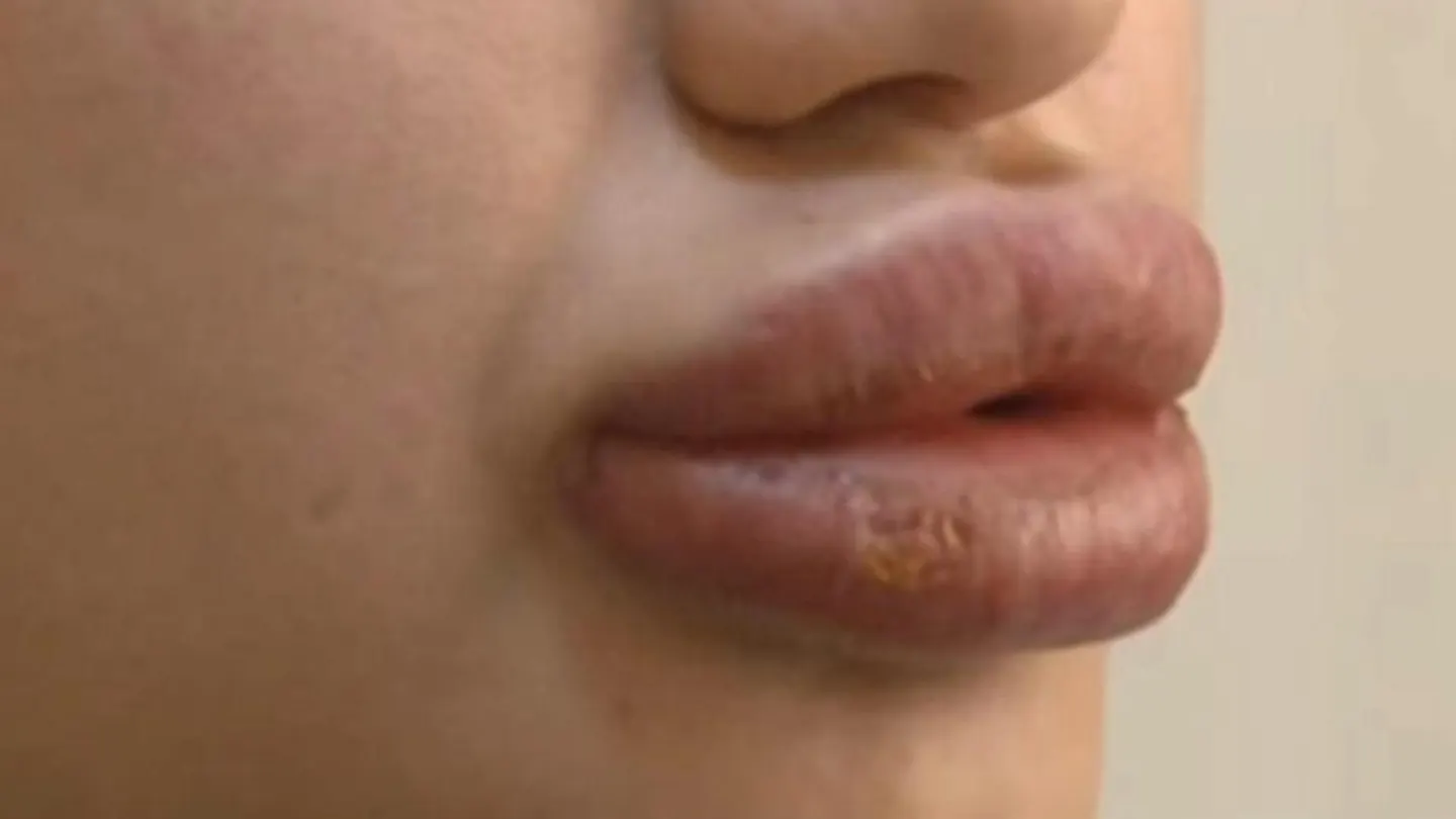 Labios de Merve Kales tras la inyección de la sustancia desconocida Labios de Merve Kales tras la inyección de la sustancia desconocida