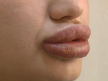 Labios de Merve Kales tras la inyección de la sustancia desconocida Labios de Merve Kales tras la inyección de la sustancia desconocida