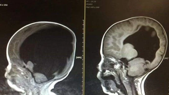 Noah Wall, el niño que desafía a la medicina con un "milagro" Noah Wall, el niño que desafía a la medicina con un "milagro"