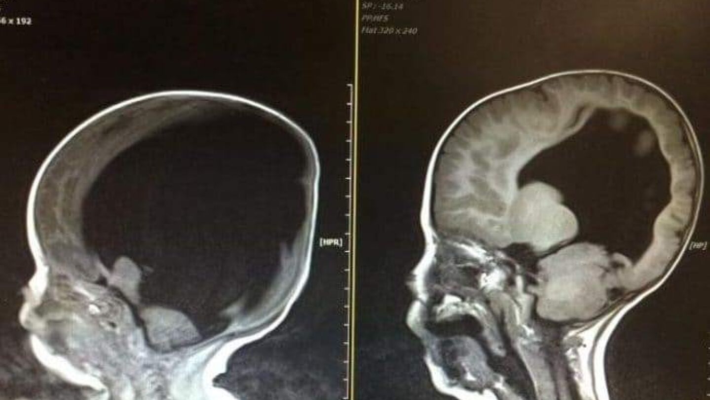 Noah Wall, el ni&ntilde;o que desaf&iacute;a a la medicina con un "milagro"