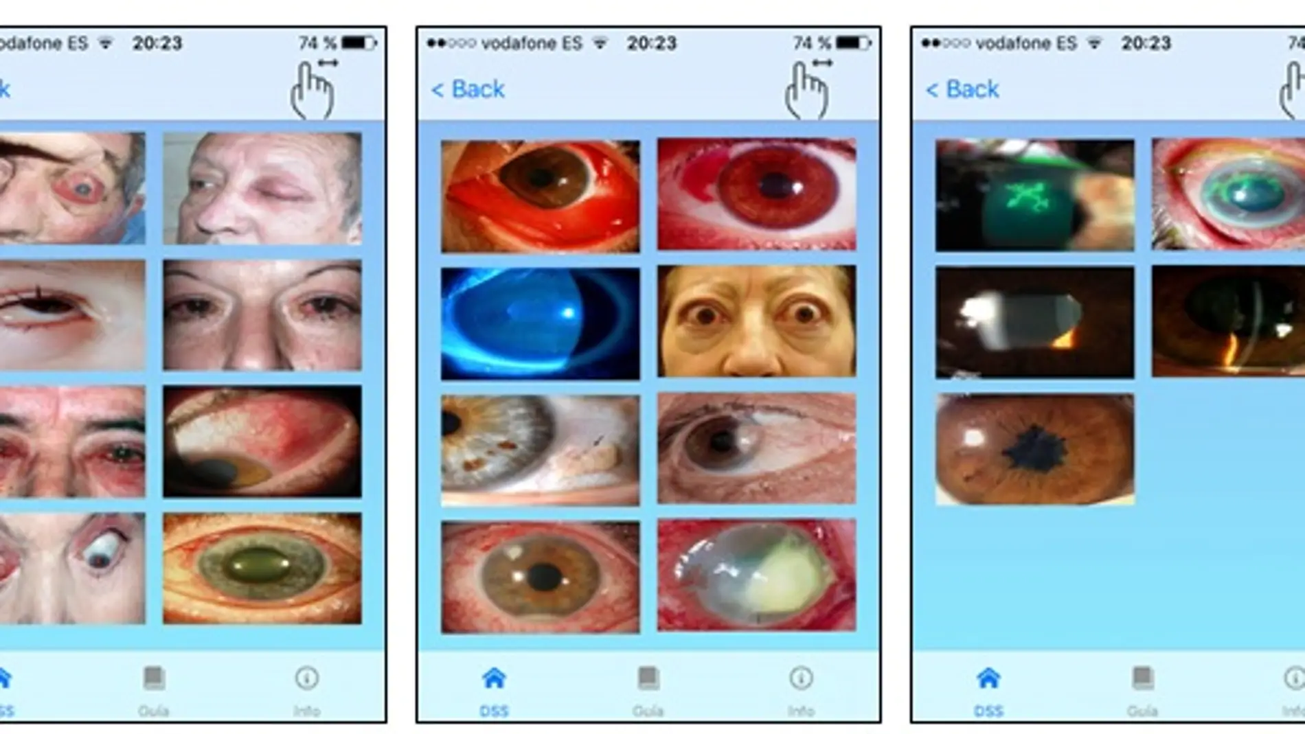 Nueva app para ayudar al diagnostico oftalmologico en Atencion Primaria
