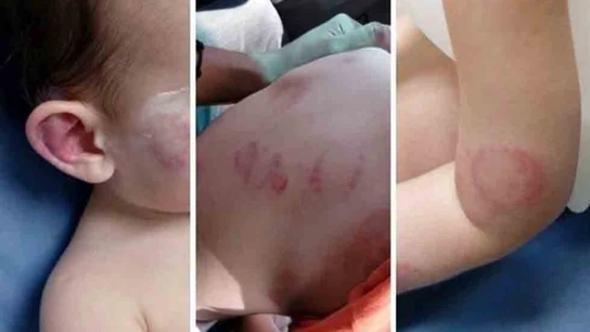 Mordiscos en el cuerpo del pequeño Mordiscos en el cuerpo del pequeño