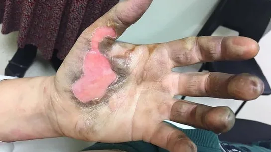 La joven quiere advertir de los peligros de los cigarrillos electrónicos Una mujer sufre quemaduras de tercer grado al explotarle un cigarrillo eléctrico en el bolsillo