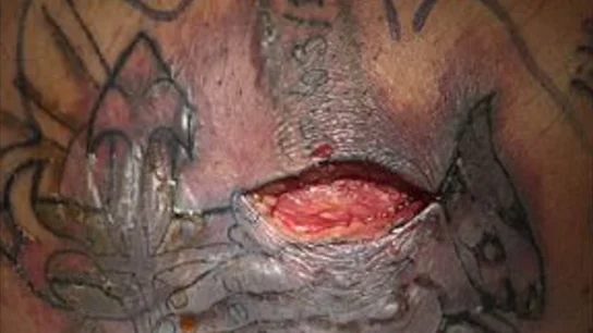 La herida provocada por la bacteria en el tatuaje La herida provocada por la bacteria en el tatuaje