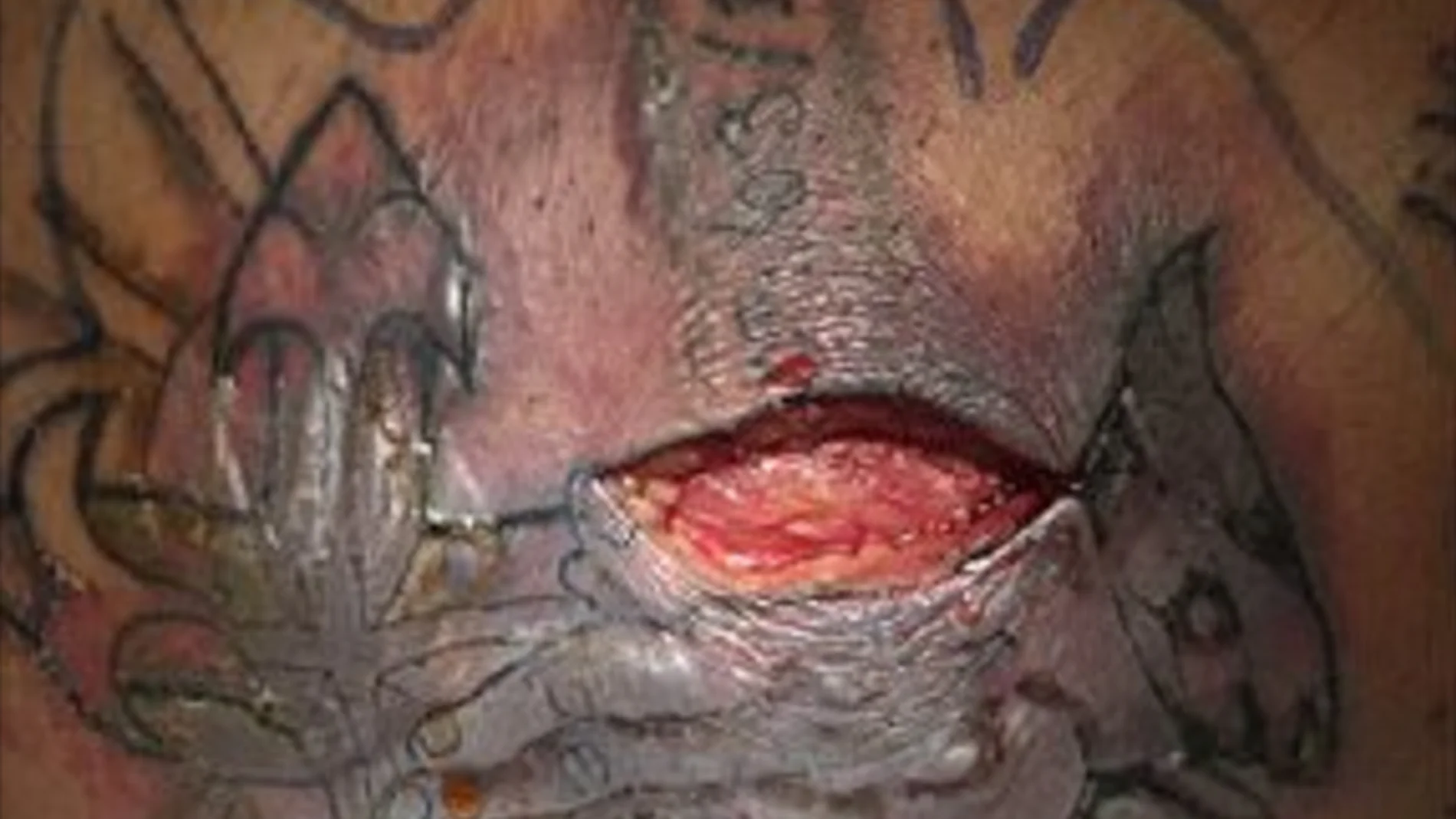 La herida provocada por la bacteria en el tatuaje