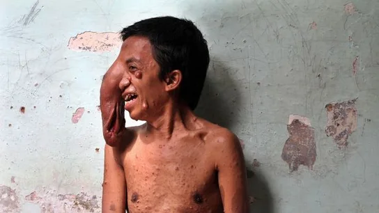 Un hombre de Indonesia con un tumor gigante en el ojo Un hombre de Indonesia con un tumor gigante en el ojo