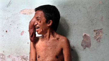 Un hombre de Indonesia con un tumor gigante en el ojo 