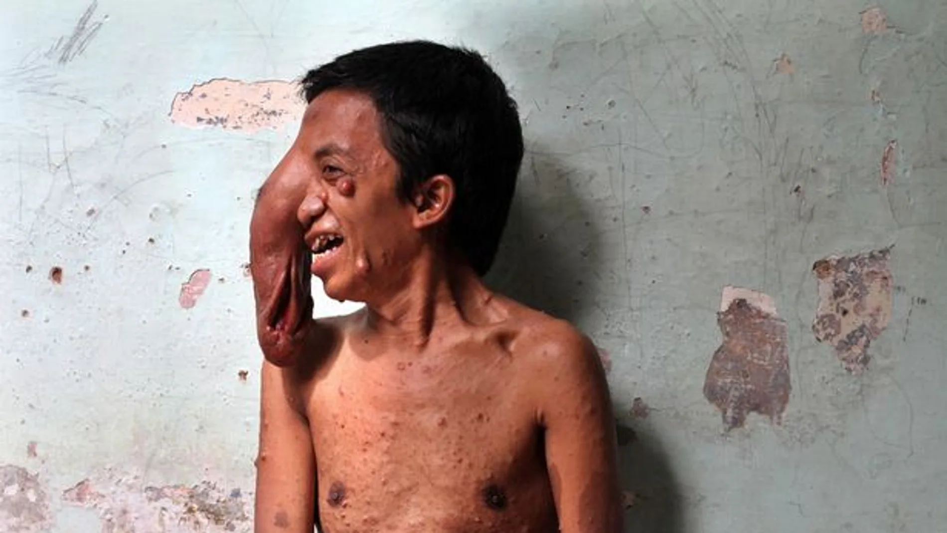Un hombre de Indonesia con un tumor gigante en el ojo 