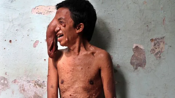 Un hombre de Indonesia con un tumor gigante en el ojo 