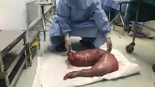 Un cirujano con el intestino de 13 kilos Un cirujano con el intestino de 13 kilos