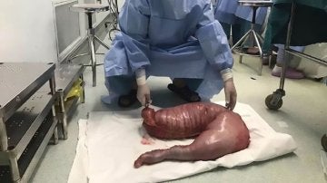 Un cirujano con el intestino de 13 kilos