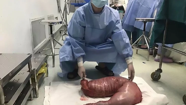 Un cirujano con el intestino de 13 kilos