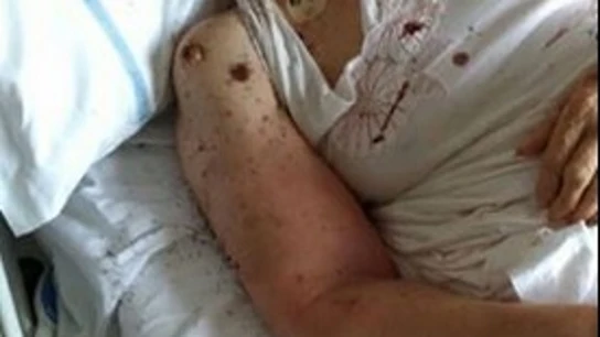 Mujer con hormigas en su cama del hospital Mujer con hormigas en su cama del hospital