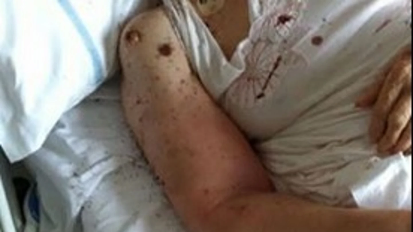 Mujer con hormigas en su cama del hospital Mujer con hormigas en su cama del hospital