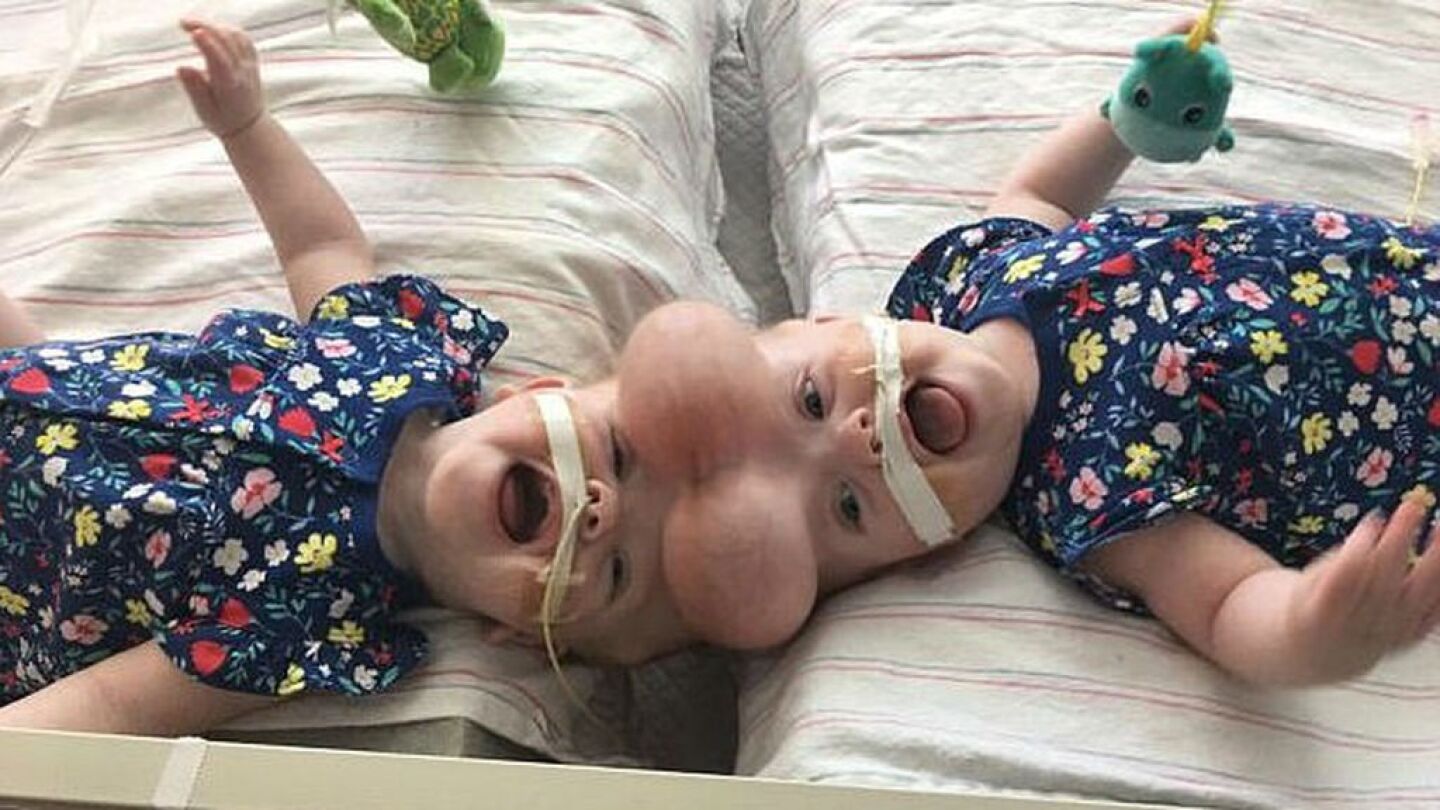 Dos hermanas unidas por el cr&aacute;neo 