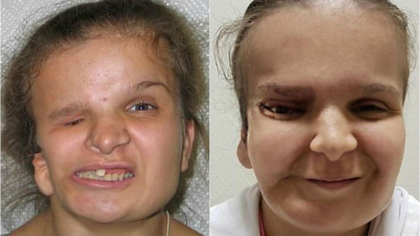La joven Katya Badaeva antes y despu&eacute;s de someterse a una de las operaciones