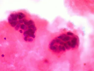 Metástasis Metástasis