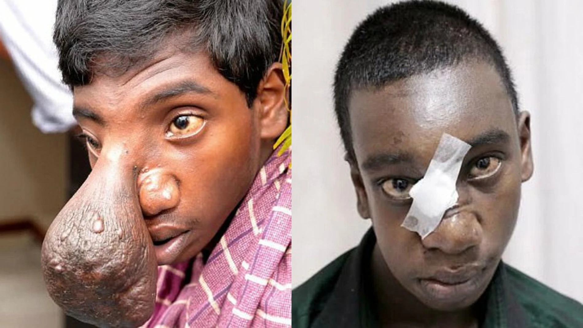 El joven Manikandan tras someterse a la operación
