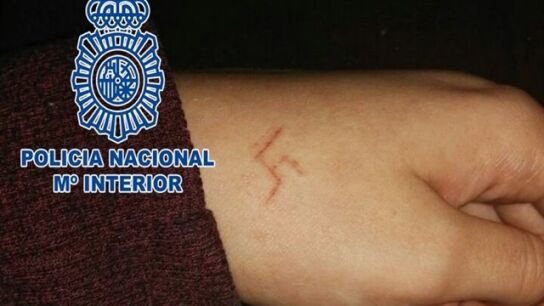 La marca que dejaron en la mano de la chica 