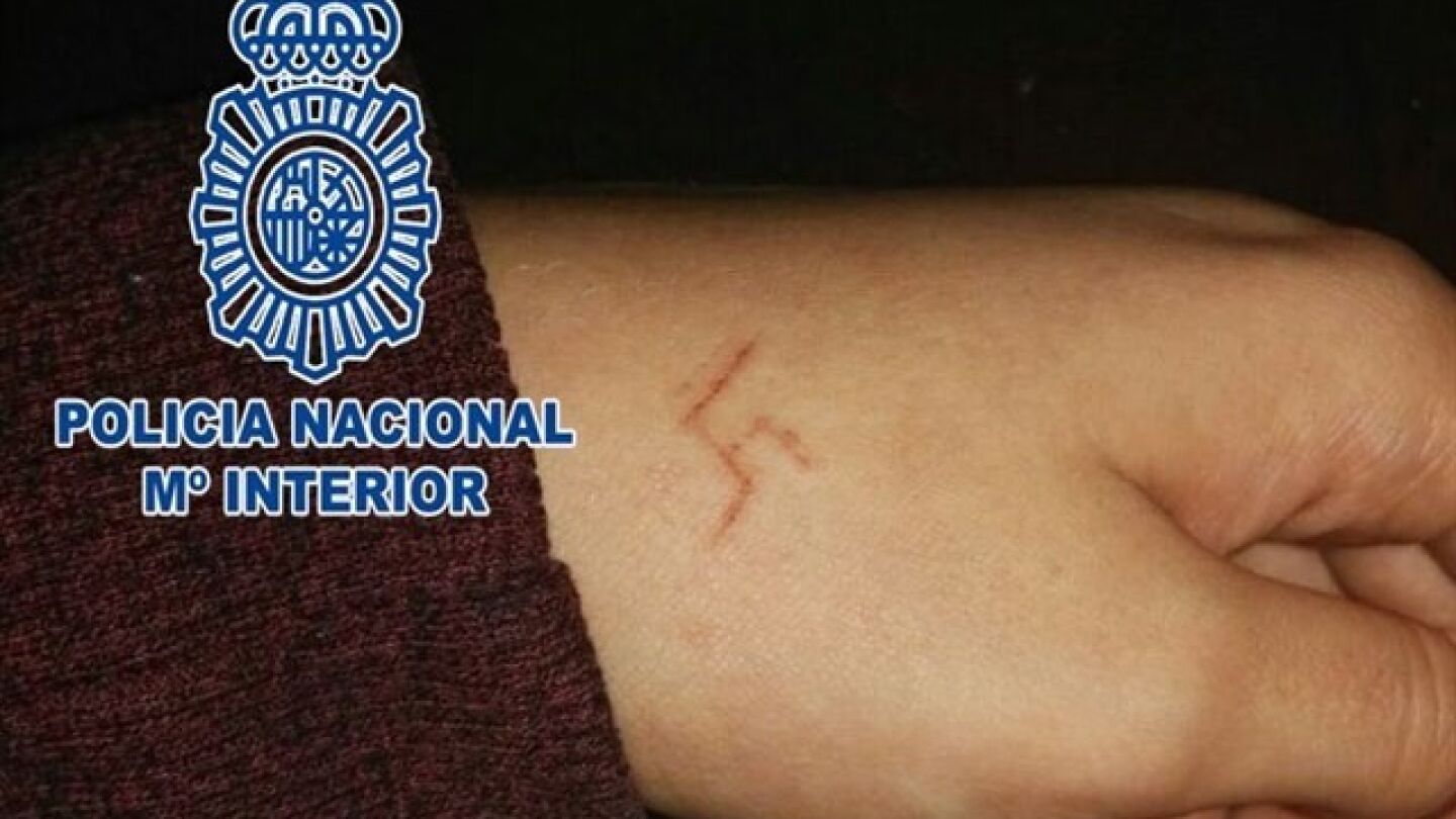 La marca que dejaron en la mano de la chica 