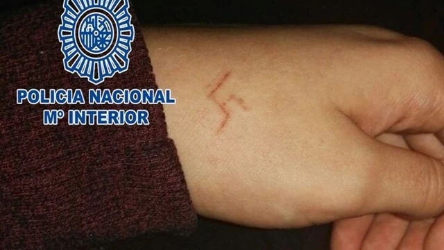 La marca que dejaron en la mano de la chica 