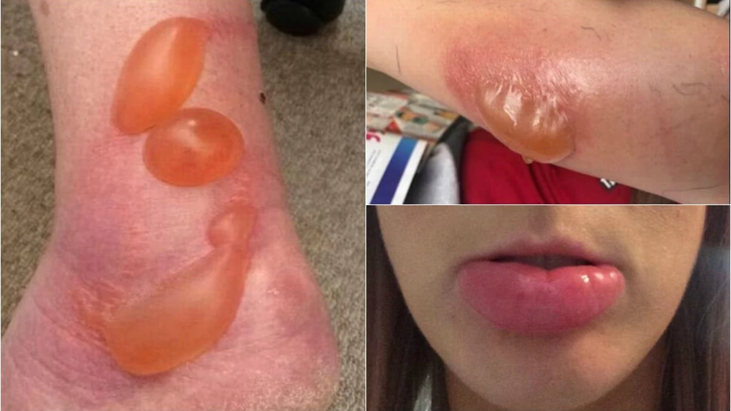 Las consecuencias de las picaduras de moscas de caballo Las consecuencias de las picaduras de moscas de caballo