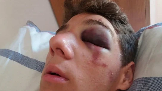 Álex después de la agresión Álex después de la agresión