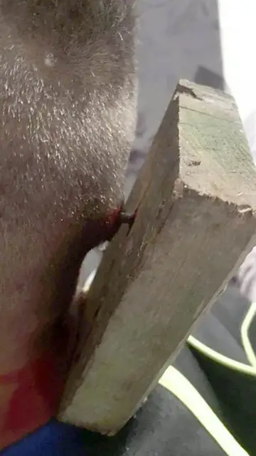 El pequeño Romeo Smith, con el trozo de madera clavado en la cabeza El pequeño Romeo Smith, con el trozo de madera clavado en la cabeza