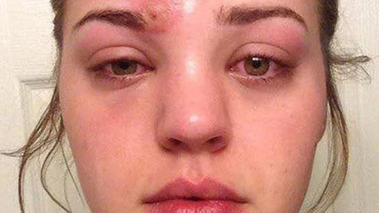 Se le infectó una espinilla con un pincel de maquillaje que casi le cuesta la vida  Se le infectó una espinilla con un pincel de maquillaje que casi le cuesta la vida