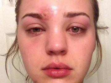 Se le infectó una espinilla con un pincel de maquillaje que casi le cuesta la vida Se le infectó una espinilla con un pincel de maquillaje que casi le cuesta la vida